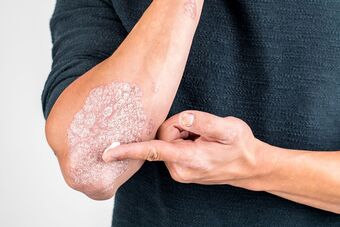 Applying the cream to the skin area damaged by psoriasis