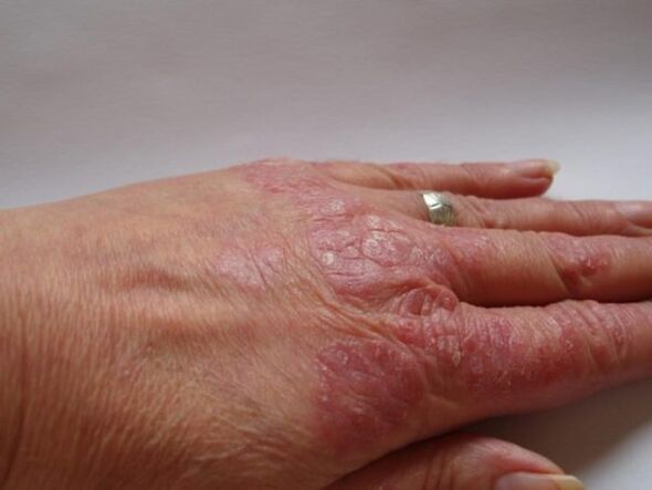 psoriatic plaques on the hands