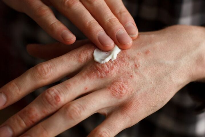 treatment of psoriasis in the hands of a child