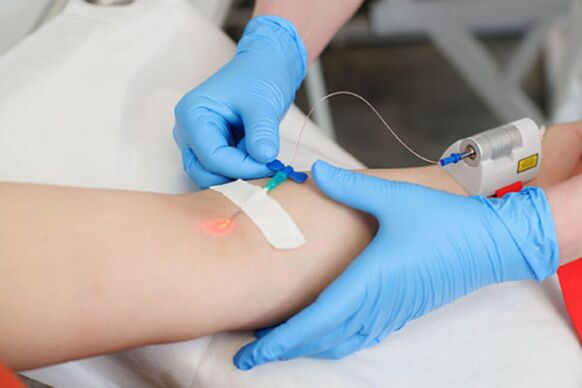 intravenous laser treatment for psoriasis on the legs