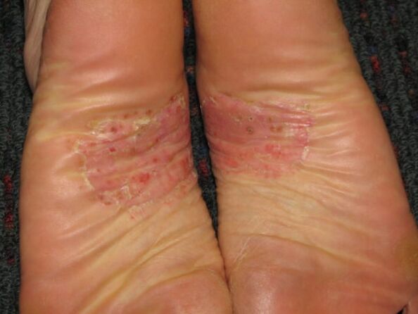 psoriasis on the feet
