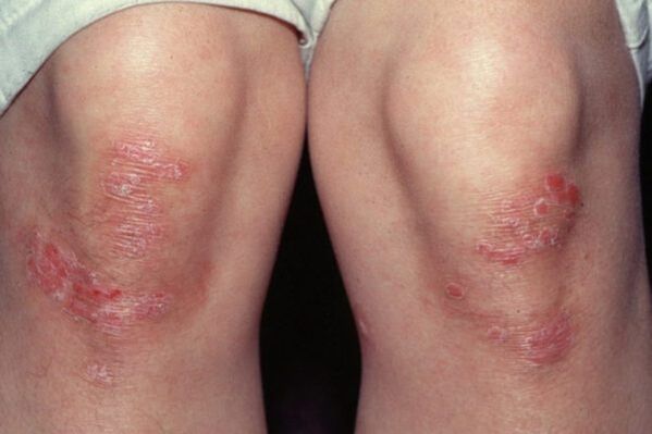 psoriasis on the knees