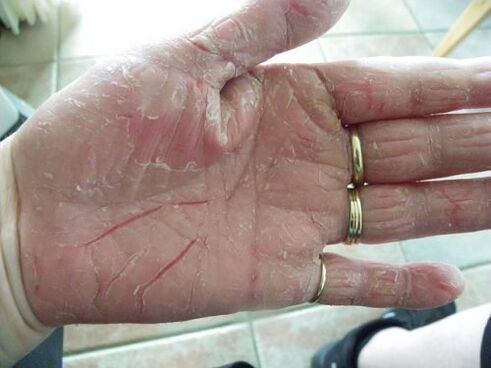 psoriasis in the palm of your hand