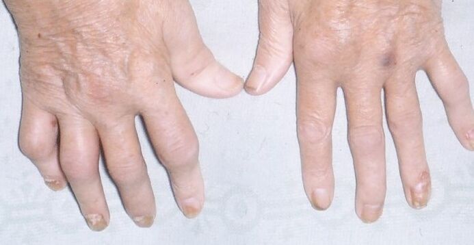 arthropathic psoriasis on the hands