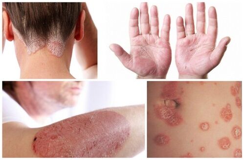 psoriasis symptoms on the body