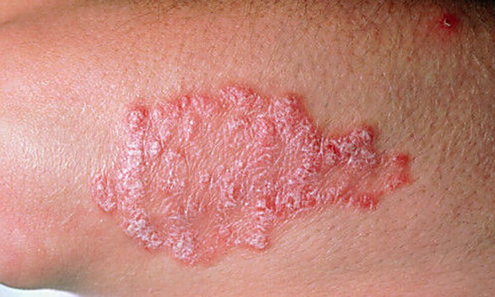 plaque psoriasis