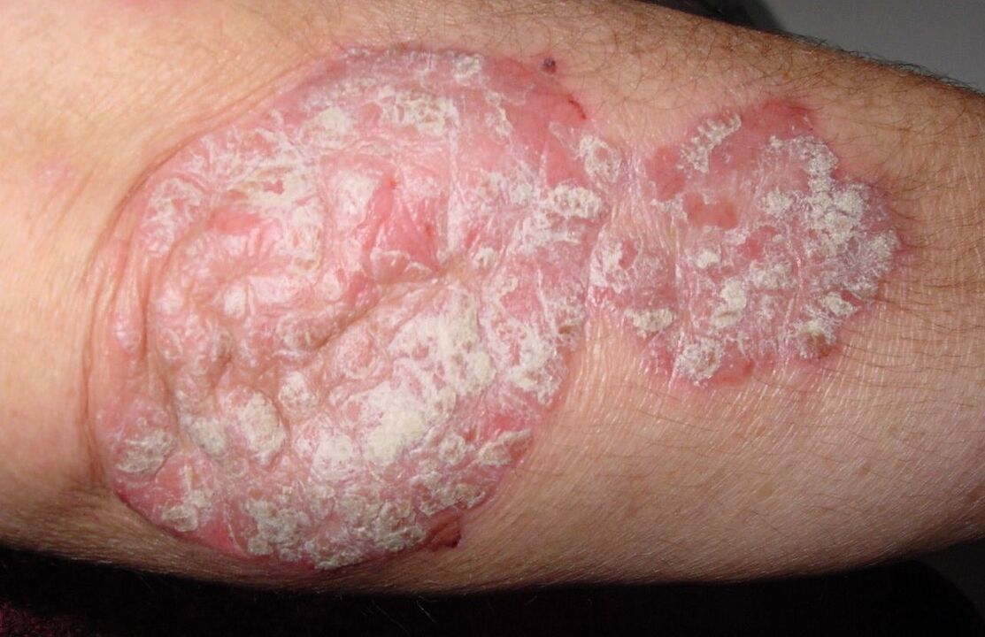 psoriasis on the elbow