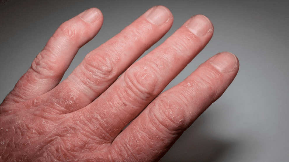 psoriatic arthritis on the hands
