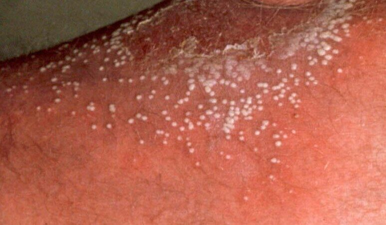 pustular psoriasis