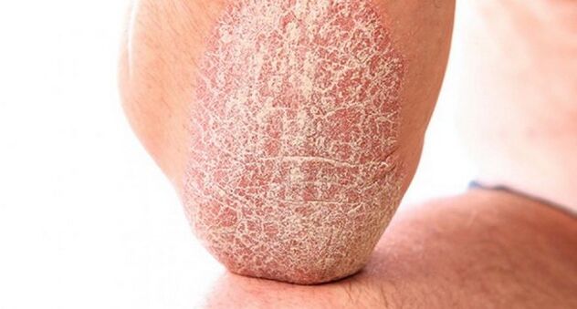 psoriasis vulgaris on the skin