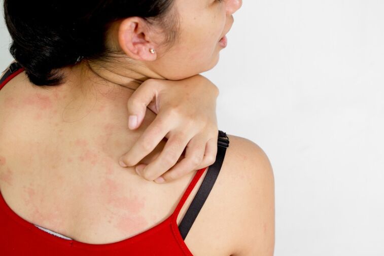 symptoms and signs of psoriasis