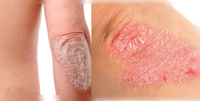 what does psoriasis look like on the skin