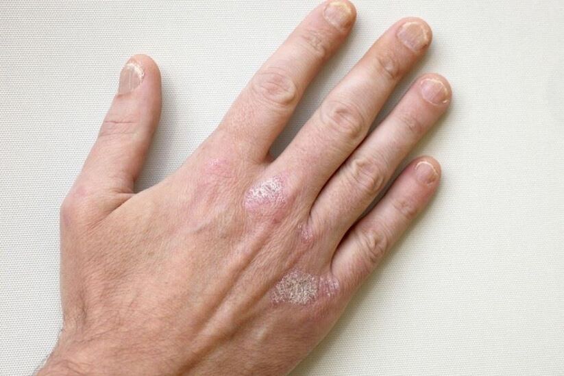 A mandatory symptom of psoriasis is plaques with scales on the skin