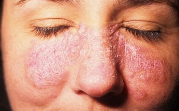 psoriasis on the face