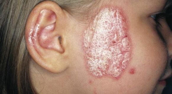 psoriatic plaque on the face