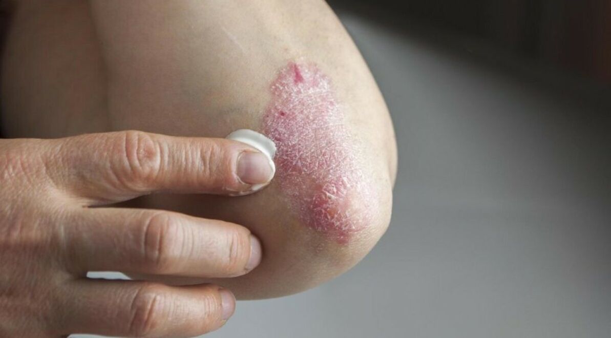 Psoriasis affecting the skin, the treatment of which includes the use of ointments
