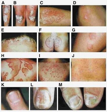 Signs of psoriasis depending on the type of disease