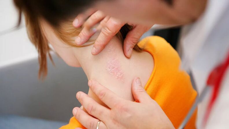 scales and plaques of psoriasis on the back of the neck