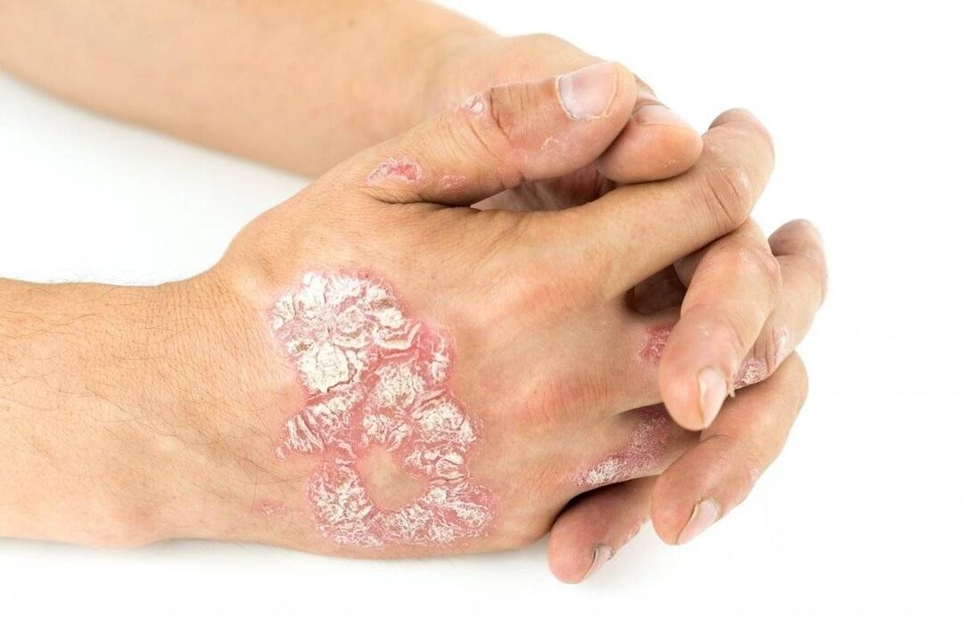 exacerbation of psoriasis on the hands