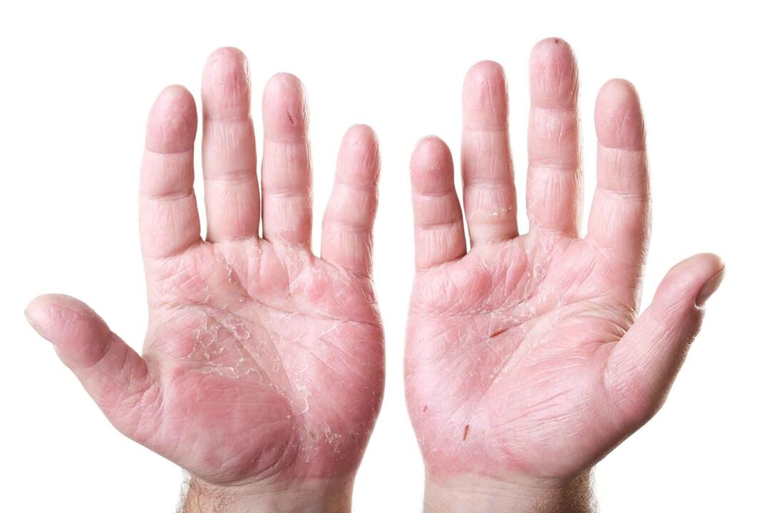 types of psoriasis on the palms