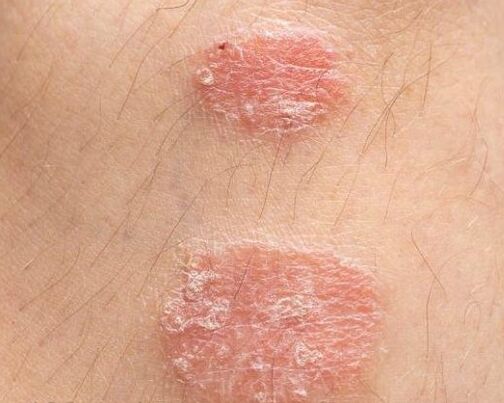 Appearance of psoriatic plaques