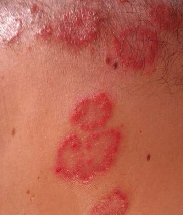 Psoriasis spots