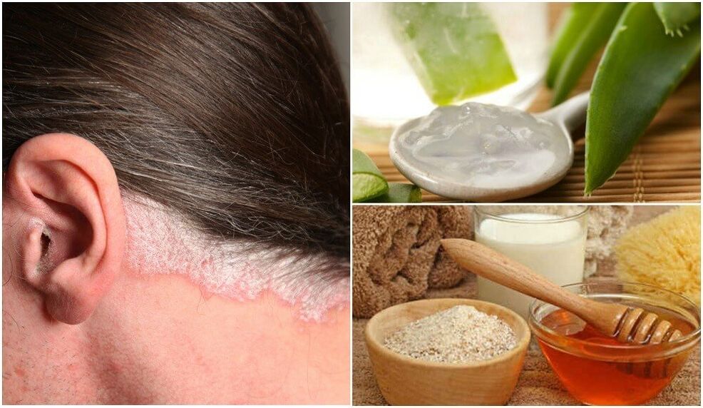 Treatment of psoriasis with folk remedies