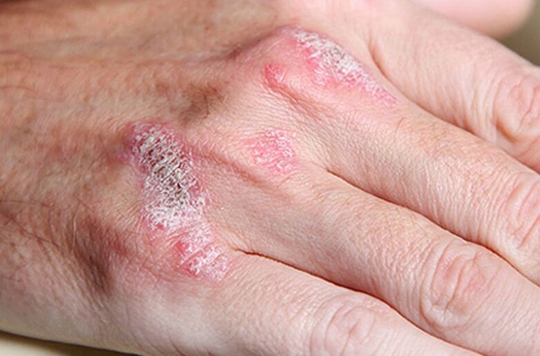 Ladomary-sustained psoriasis