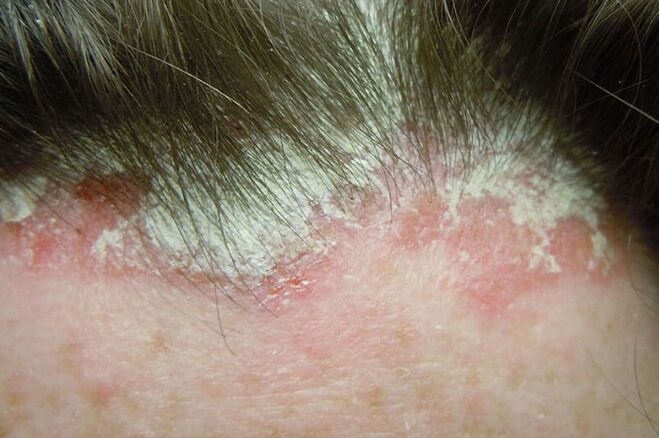 Psoriasis captures the entire hairy part of the head