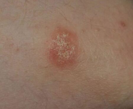 Psoriasis spot
