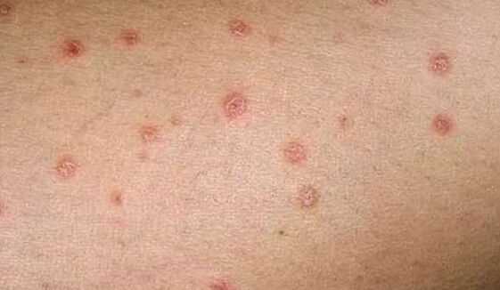 The initial stage of psoriasis