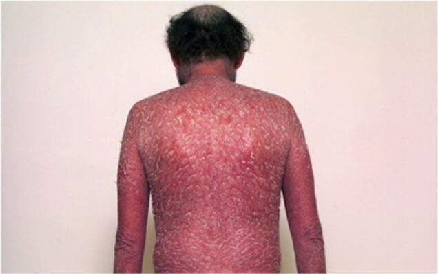 The third stage of psoriasis