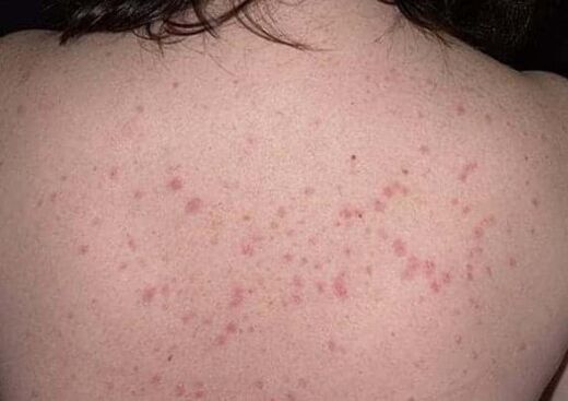 The initial stage of psoriasis