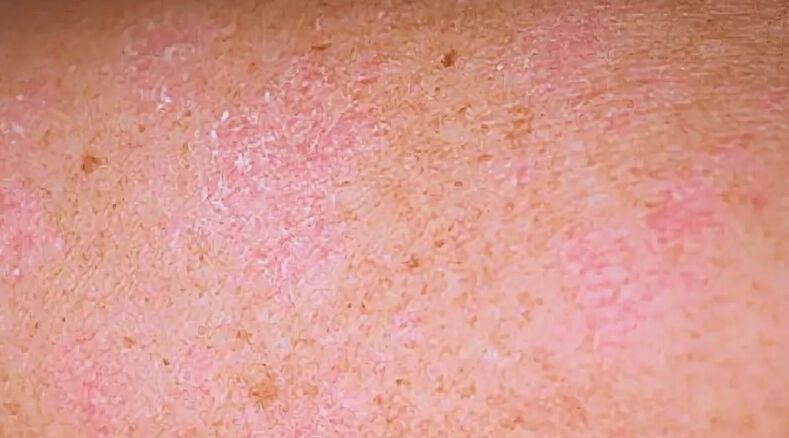 The regressive stage of psoriasis