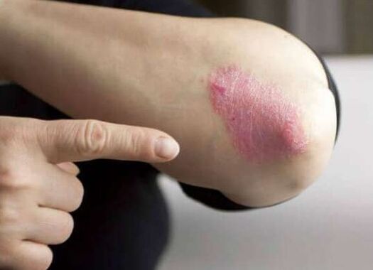 The stationary stage of psoriasis
