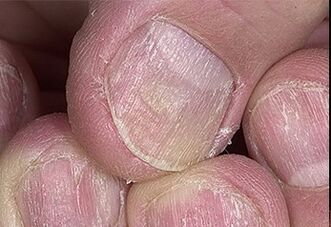 Psoriasis of nails
