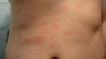 Psoriasis on the stomach