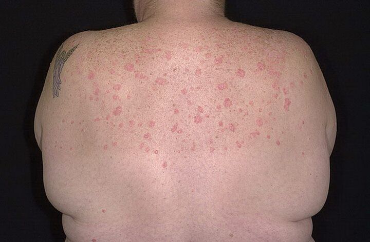 Psoriasis on the shoulders