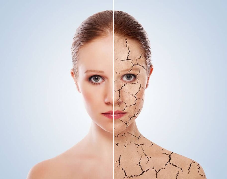 Healthy skin and psoriasis-affected skin