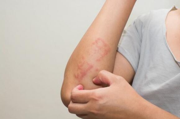 The latest methods of treating psoriasis