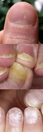 Nail psoriasis - initial stage