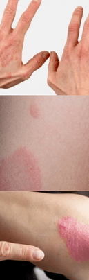 Psoriasis of the initial stage on the hands