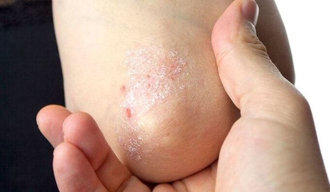 symptoms of psoriasis at the initial stage