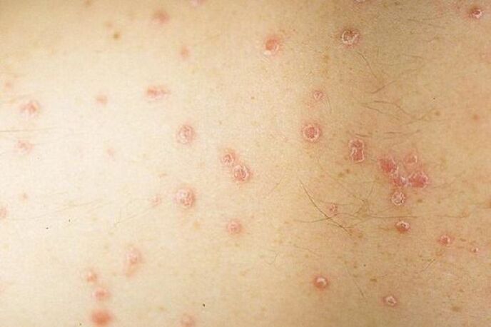 symptoms of spot psoriasis