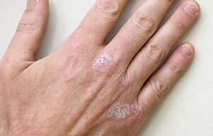 symptoms of the initial stage of psoriasis