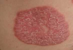 photos of psoriasis on the skin