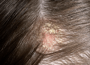 the main symptoms of psoriasis on the head