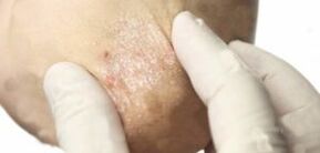 Psoriasis in the attenuation stage