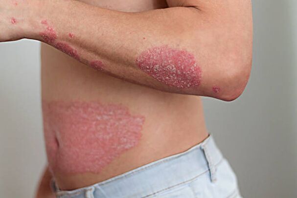 psoriasis on a man's body