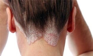 forms and stages of development of psoriasis